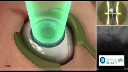 Bir İnci Göz - iLasik Animasyonu