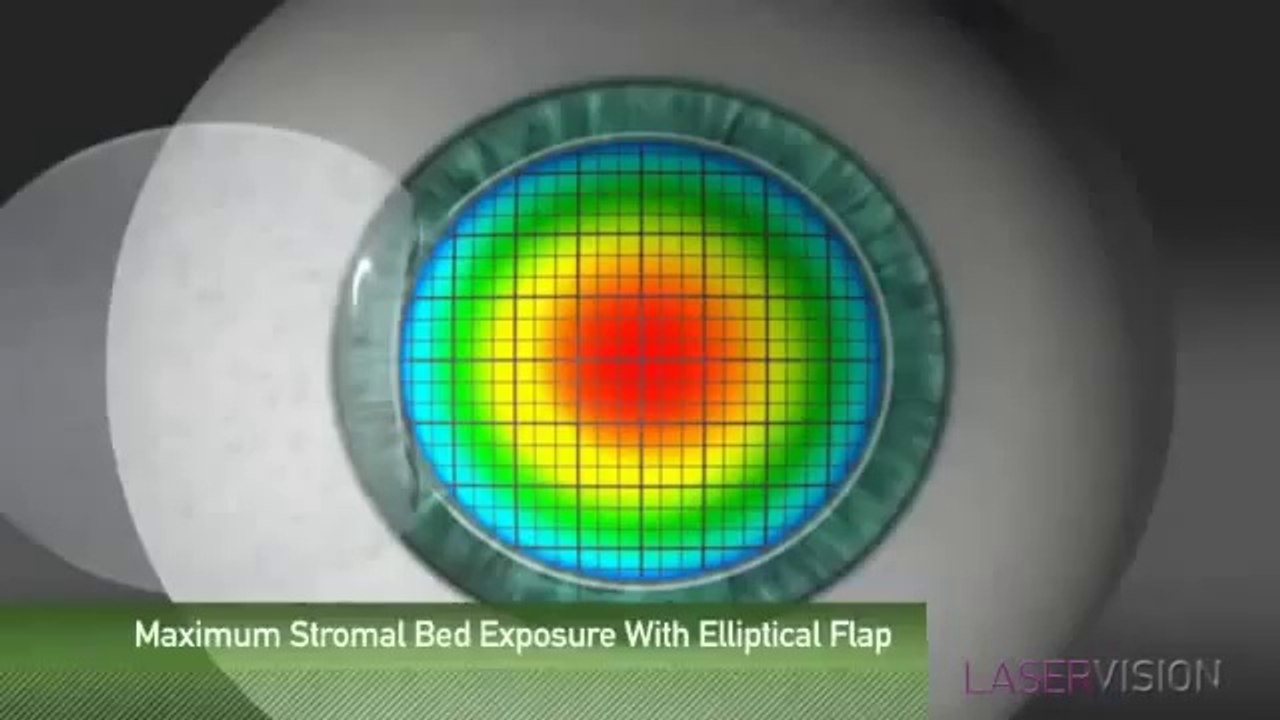 Bir İnci Göz - IntraLASIK™