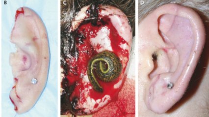 Doctors Use Leeches to Reattach Woman's Ear