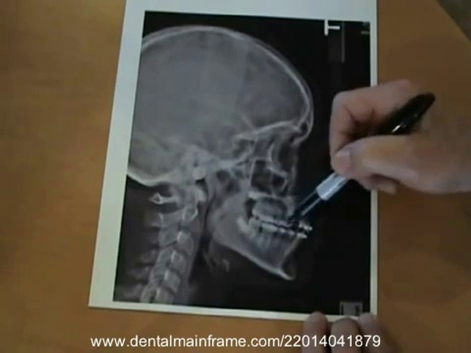 Dr Yosh Jefferson Demonstrates his Cephalometric Analysis (Part 1_2)_(new)