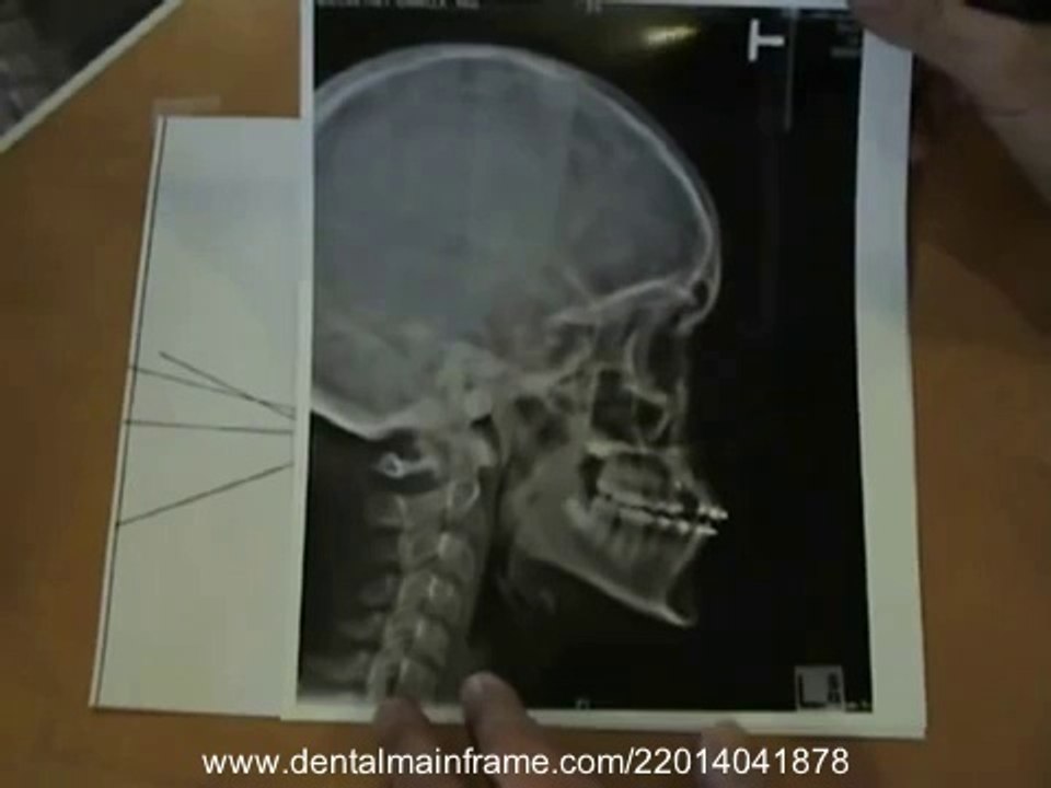 Dr Yosh Jefferson Demonstrates his Cephalometric Analysis (Part 2_2)_(new)