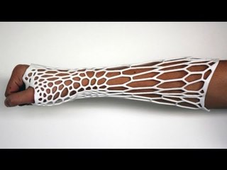 3D-printed Cortex Exoskeleton may be the future of orthopedic casts