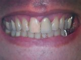 Before and After Porcelain Veneers Austin Lakeway TX