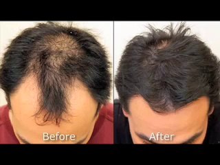 Neograft Hair Restoration Services in Long Island | American Hair Restoration