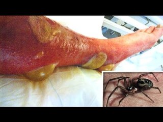 Outbreak of Britain's most venomous spider forces school shutdown