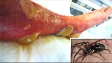 Outbreak of Britain's most venomous spider forces school shutdown