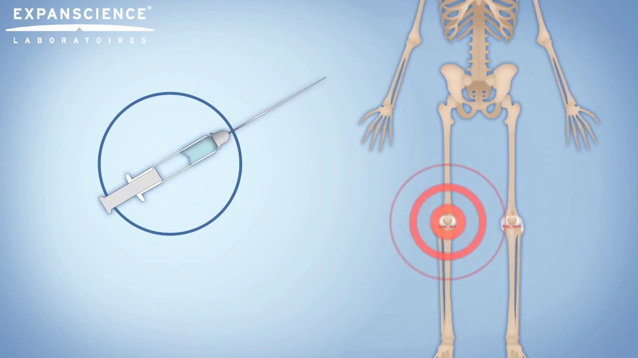 Infiltration, viscosupplémentation traitement Arthrose genou | Arthrolink.com