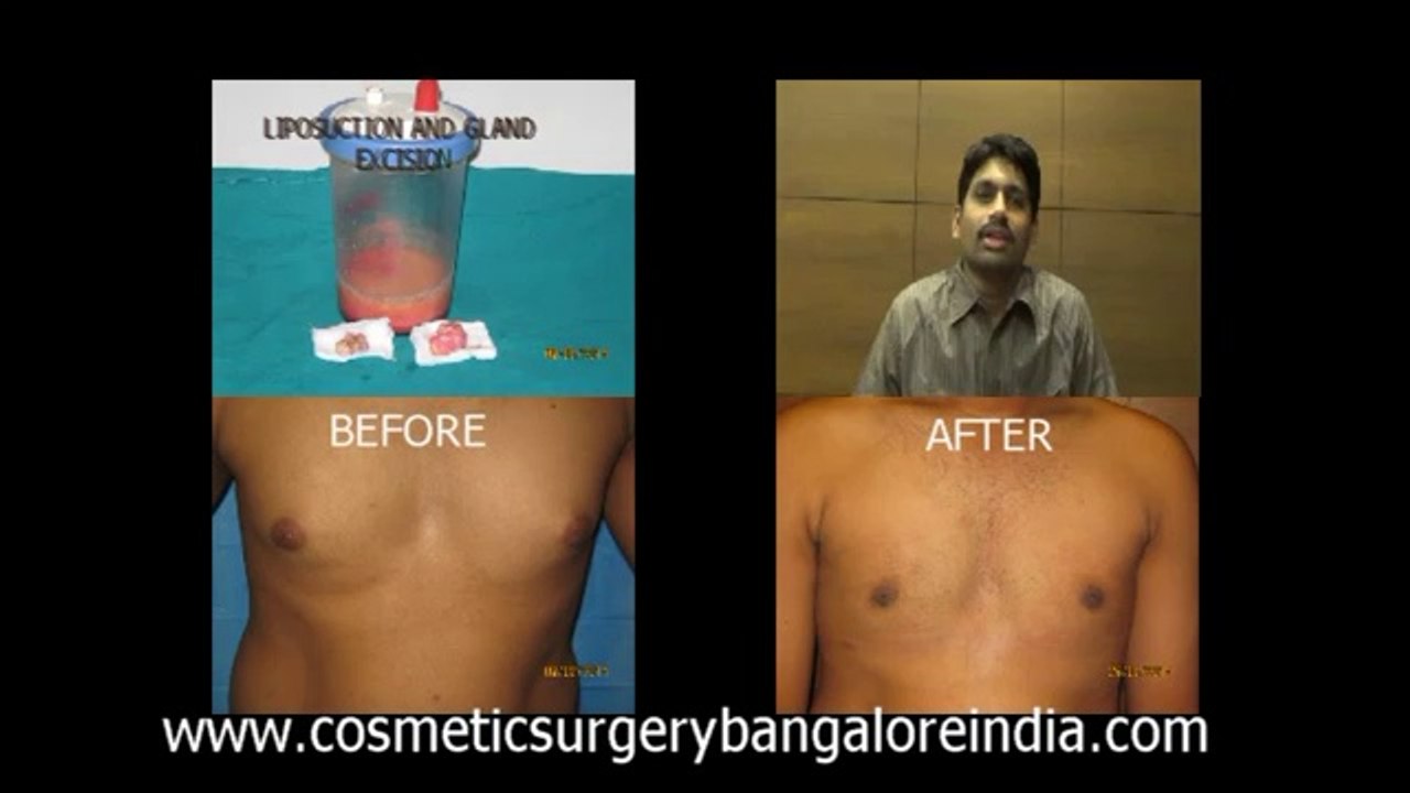 Male breast reduction, Bangalore, review