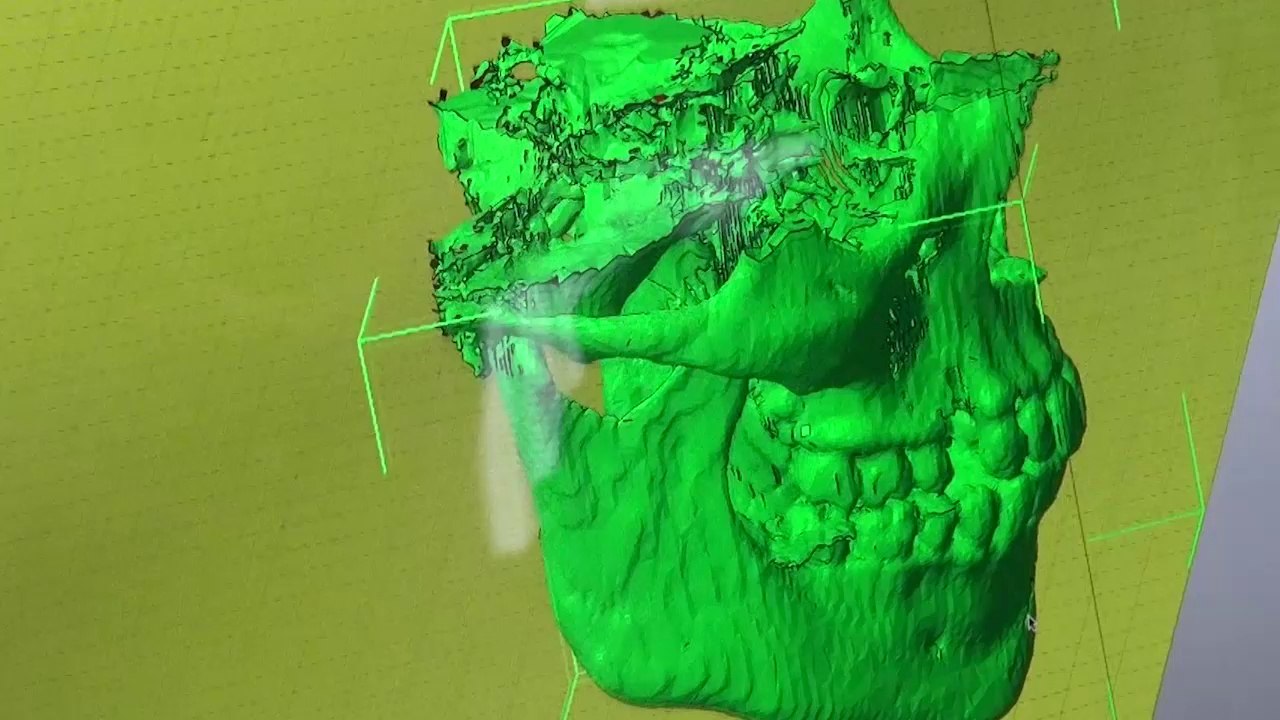 Imprimante 3D, CHU Dijon - 1/3