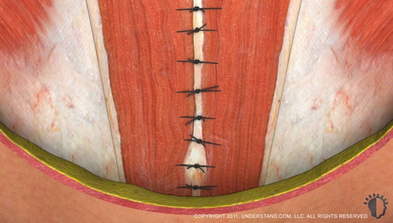 Tummy Tuck - Mini / Karın Germe - Mini