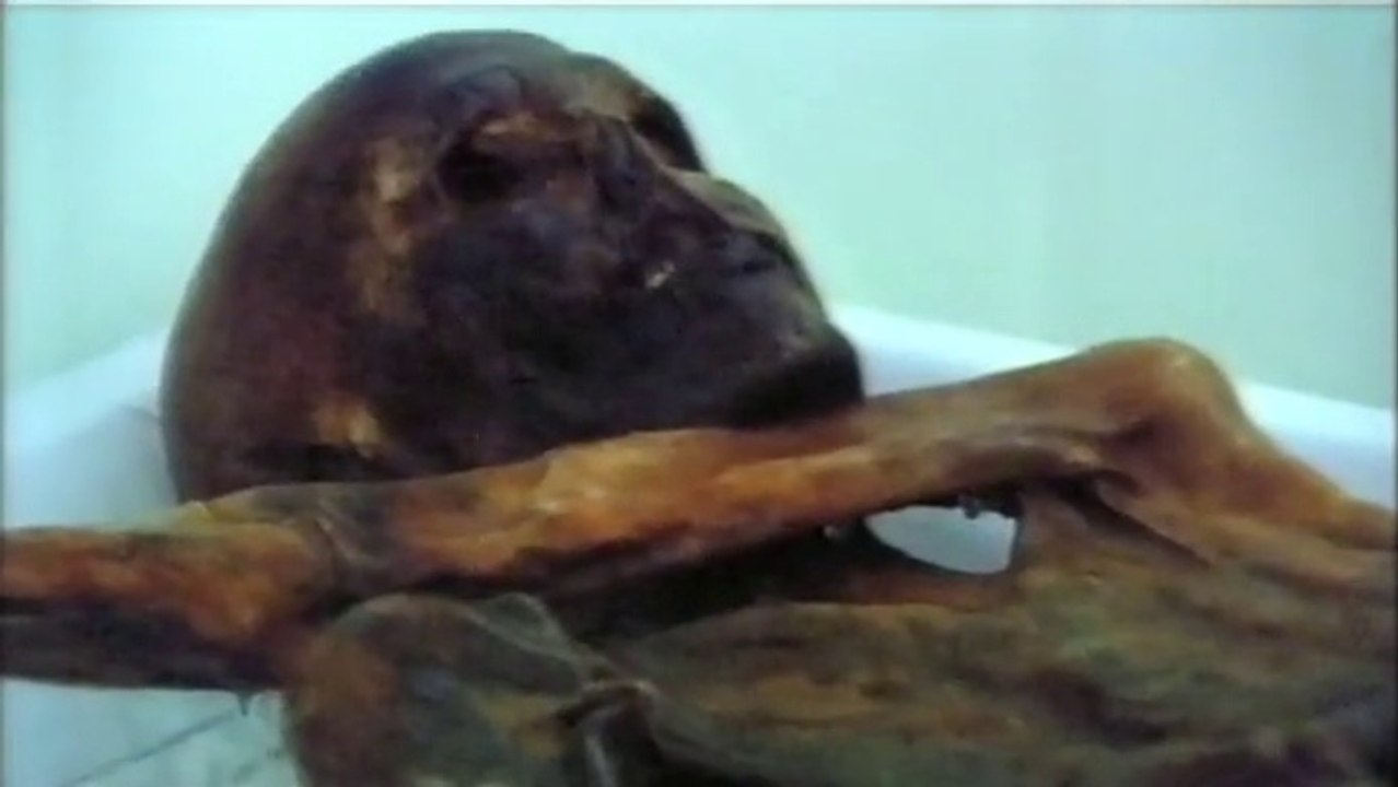 Stone Age acupuncture / tattoos (Ötzi the Iceman)