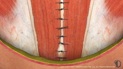 Tummy Tuck – Mini - Karın Germe - Mini