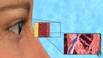Eyelid Surgery – Upper - Üst Göz Kapağı Cerrahi