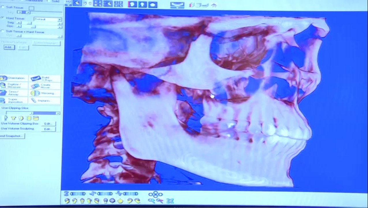 Wisdom Tooth Extraction - Lincoln