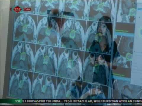 Beyin Cerrahisi - Beyin ve Sinir Cerrahisi Uzmanı Prof. Dr. Selçuk Paker anlatıyor.