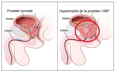 Urologie - Comment prévenir le cancer de la prostate