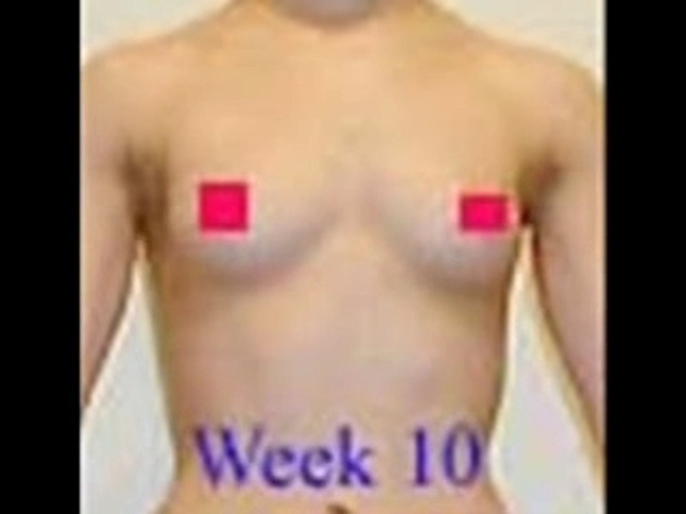 Amazing Breast Enhancement After 16 Week