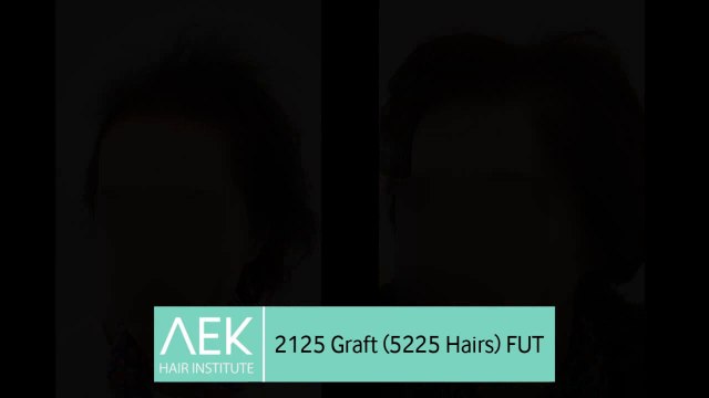 FUT Hair Transplant in Female Patient | AEK Hair Institute