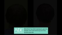 FUT FUE Saç Ekimi | AEK Hair Institute