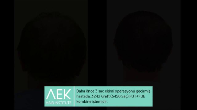 FUT+FUE Saç Ekimi | AEK Hair Institute