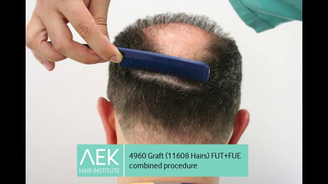 FUT+FUE Hair Transplant | AEK Hair Institute
