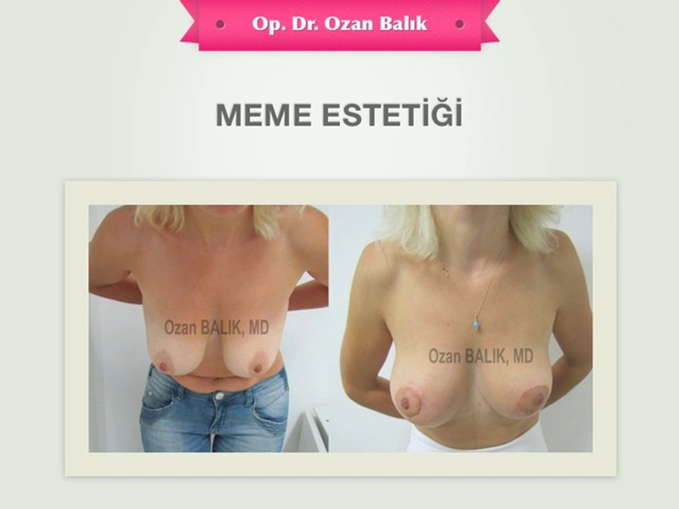 Meme Estetiği - Öncesi Sonrası Resimleri