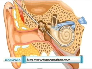 Biyonik Kulak - Doç Dr. Arif Ulubil