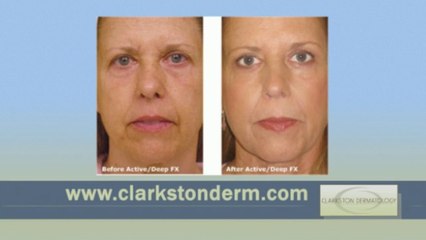 Active FX Reviews Michigan - Clarkston Dermatology