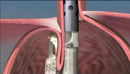 Hyperhidrosis Surgery Los Angeles