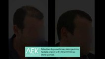FUE Saç Ekimi | AEK Hair Institute