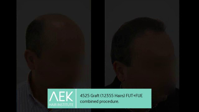 FUT+FUE Hair Transplant | AEK Hair Institute