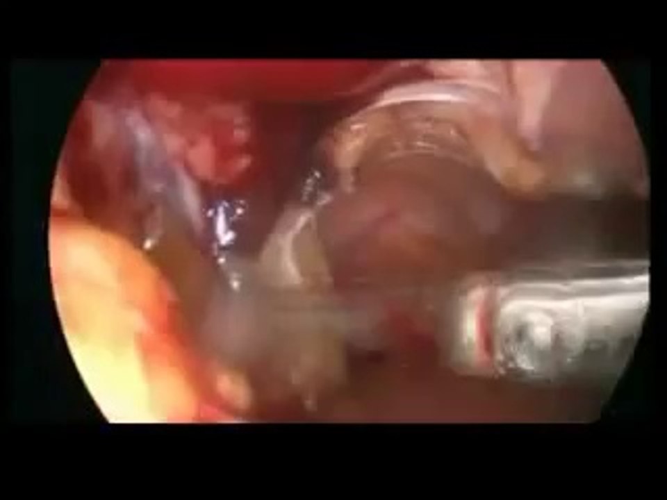 Karın içinde uterus (rahim) çevresi yapışıklık açılması (Adhezyolizis) yöntemi