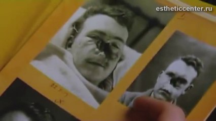 Ринопластика до и после  http://estheticcenter.ru