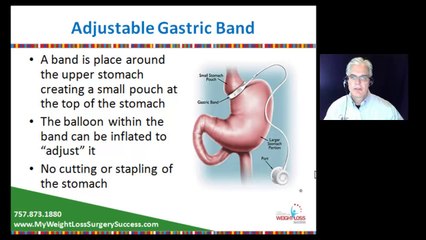 What are the best weight loss surgery options?