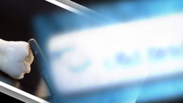 Dental Implants - Allied Dental Of Old Bridge