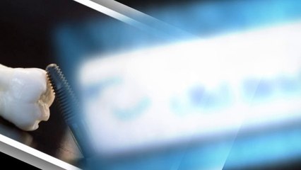 Dental Implants - Allied Dental Of Old Bridge