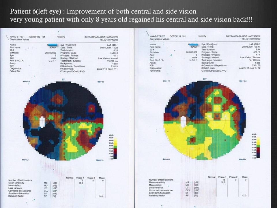 Medical Test Results of Patients with Retinitis Pigmentosa - Electro-Acupuncture Therapy - FIRATLI CLINIC