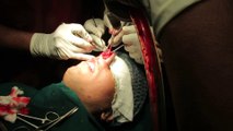 cosmetic nose surgery cost in india