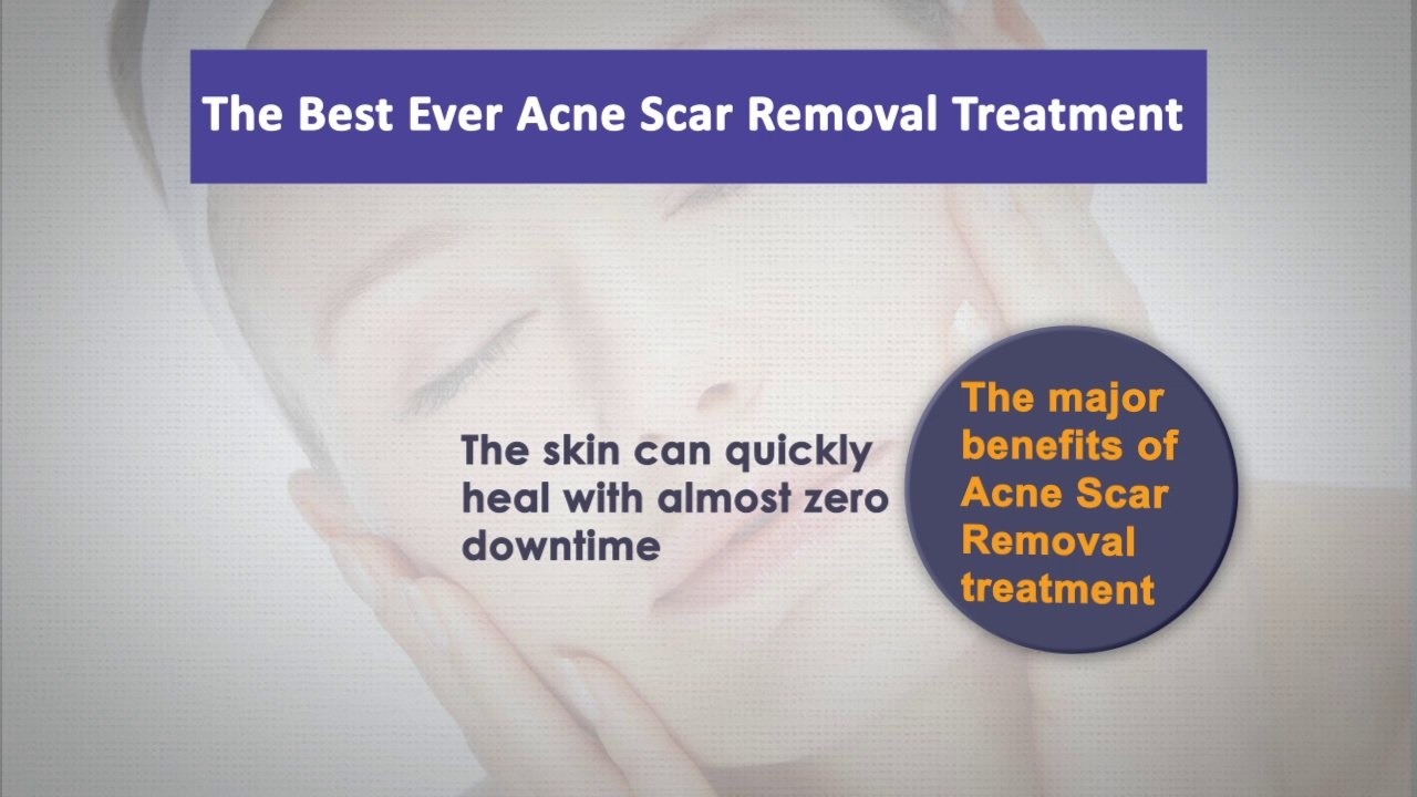 The Best Ever Acne Scar Removal Treatment