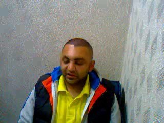 Hair Transplant FUE, Islamabad.0092-3328567658