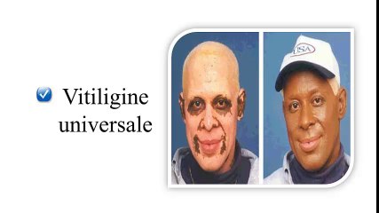 Vitiligine Cura Definitiva, Vitiligine Si Guarisce, Vitiligine Terapia, Mancanza Di Melanina