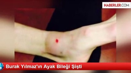 Burak Yılmaz'ın Ayak Bileği Şişti