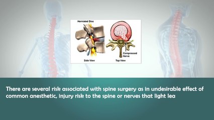 Interesting Facts about Laser Spine Surgery