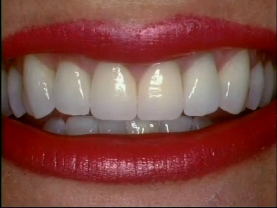 All Porcelain Crown