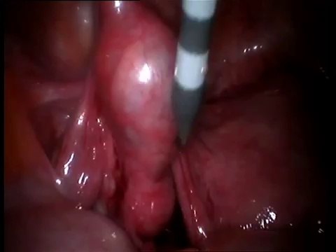 Tüplerin Korunduğu Laparoskopik dış gebelik ameliyetı