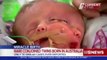 Australian Woman Gives Birth to Rare Conjoined Twins