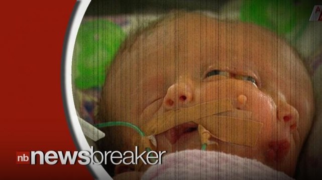 Mother Gives Birth to Baby with Two Brains and Faces, Baby Doing Well Despite Odds