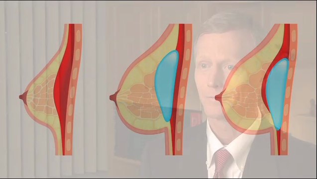 Breast Augmentation - Minneapolis - Mesna Plastic Surgery