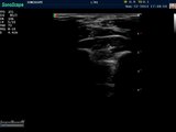 Video of the median nerve for carpal tunnel syndrome Sonoscape S8