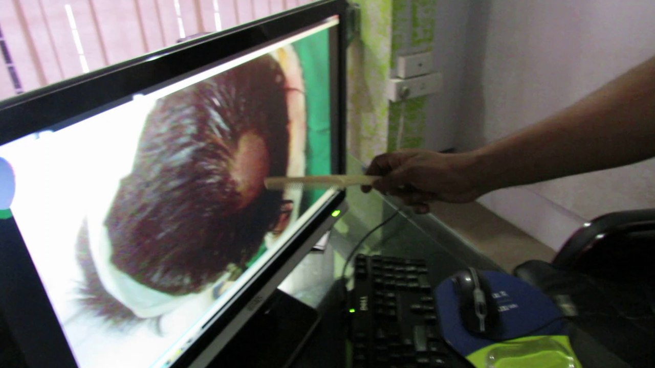 fue hair transplant results bangalore